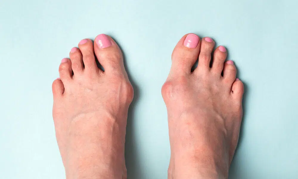 hallux valgus