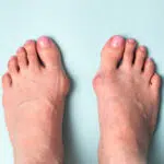 hallux valgus
