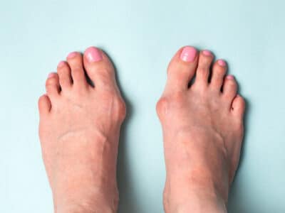 hallux valgus