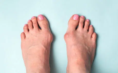 hallux valgus