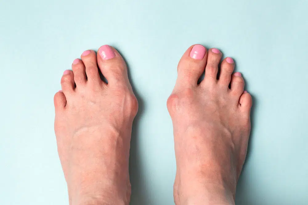 hallux valgus